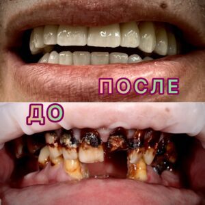 Вредны ли импланты зубов