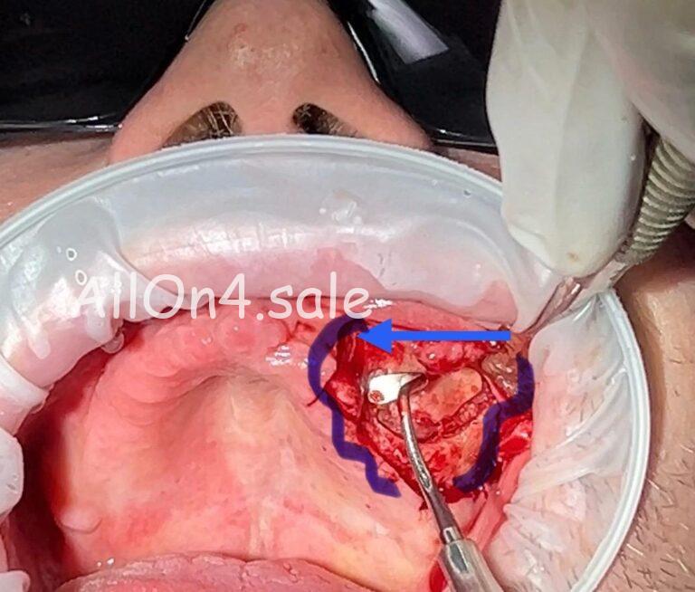 Kontur operativnoj zony pri sinus liftinge - Синус лифтинг открытый и закрытый, клинический анализ манипуляций для успешного отдалённого результата в нагрузке