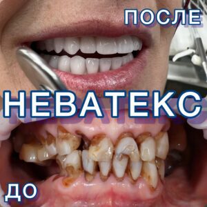 До и после протезирования