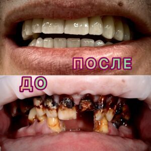 До и после протезирования