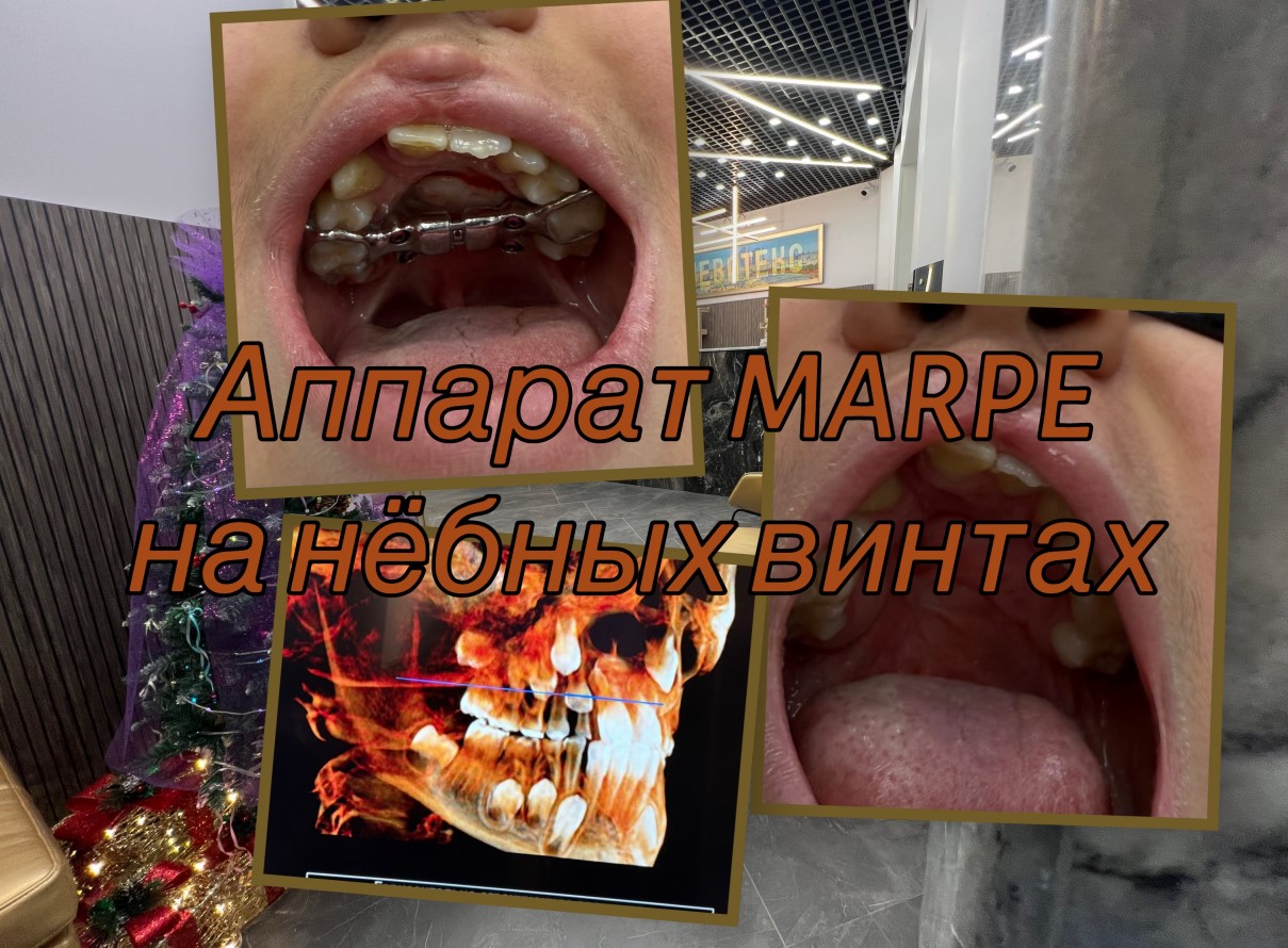 Брекеты и элайнеры — выбор системы