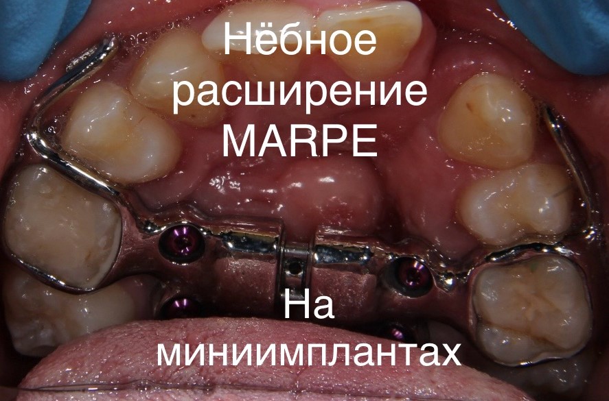 Процесс исправления прикуса