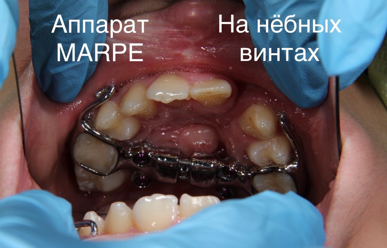 Результаты ортодонтического лечения