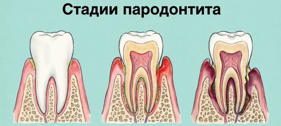 Стадии пародонтита