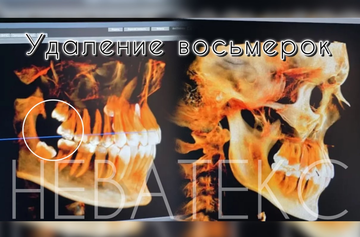 Хирургическое удаление ретинированного зуба мудрости