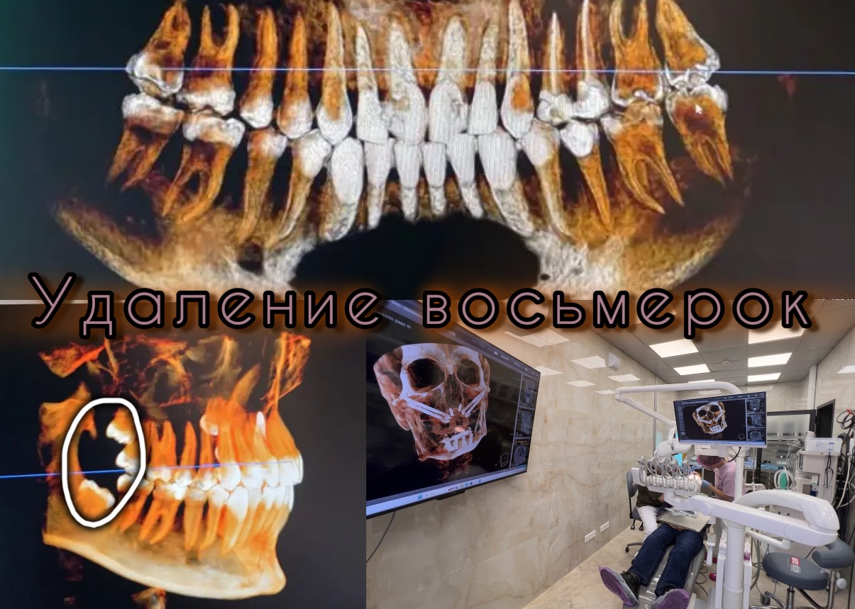 Удаление зуба мудрости на верхней челюсти