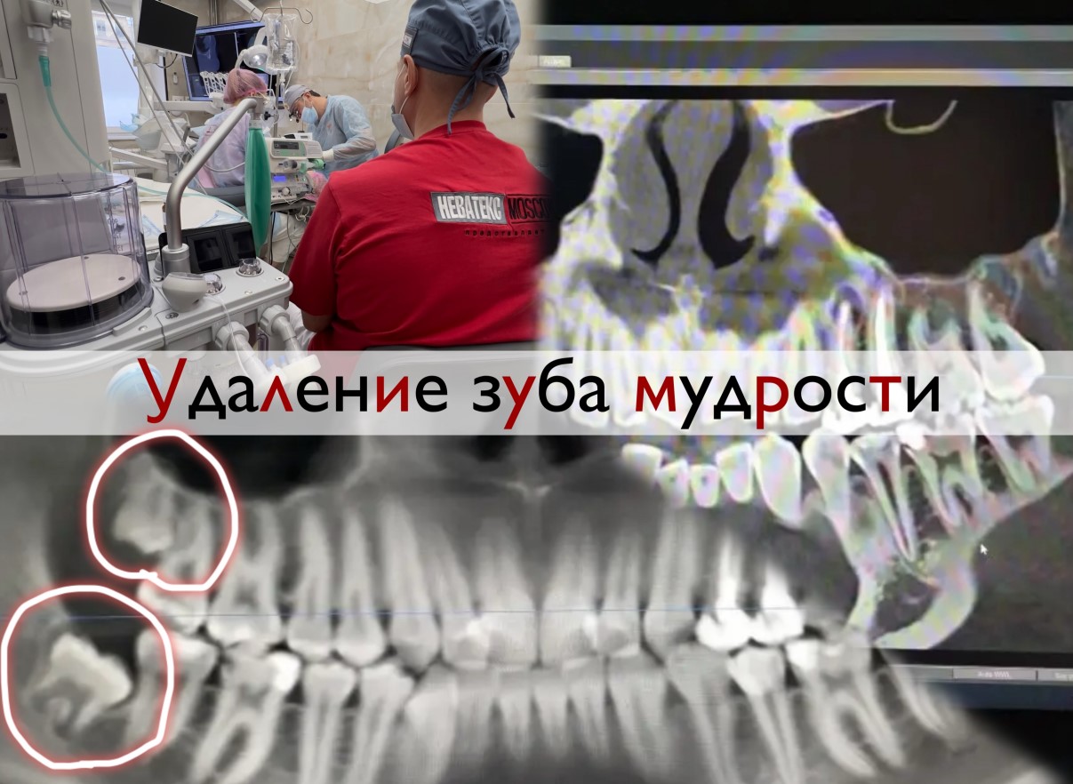 Удаление зуба мудрости — подготовка и диагностика
