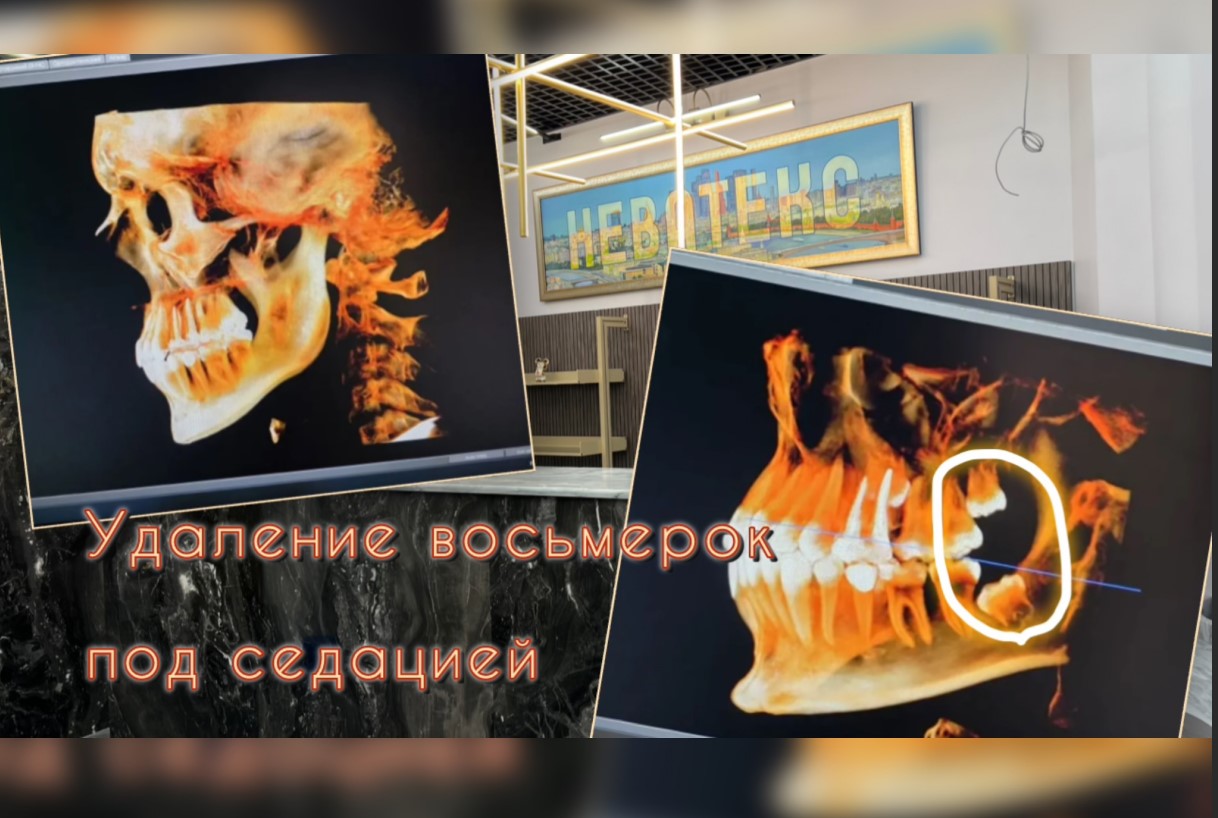 Реабилитация после удаления зуба мудрости