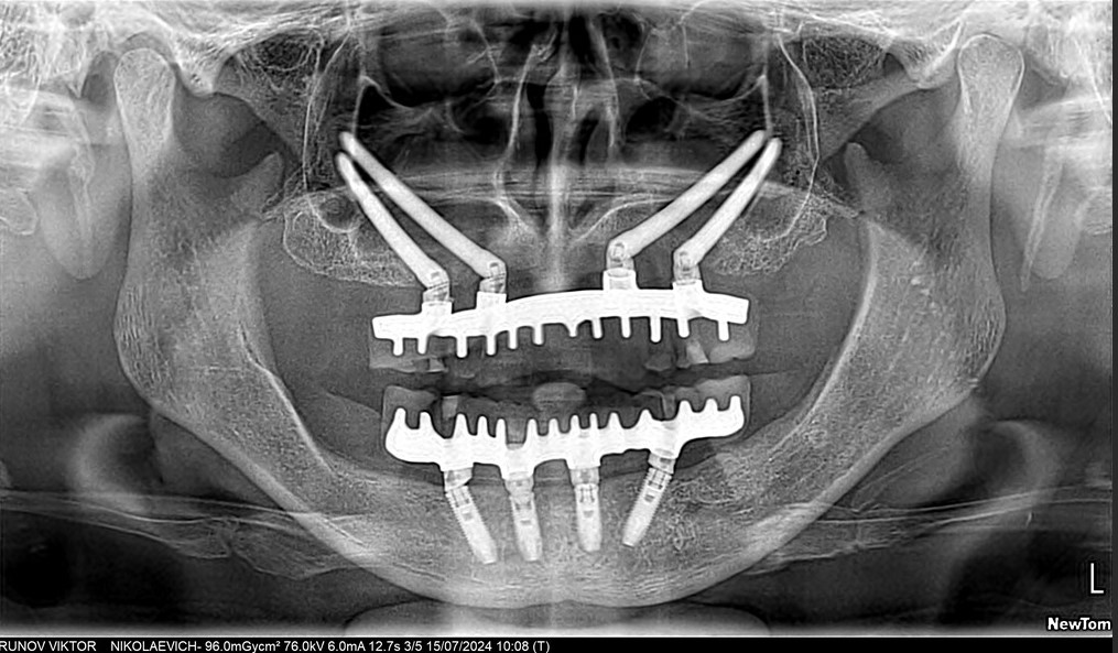 Имплантация Zygoma