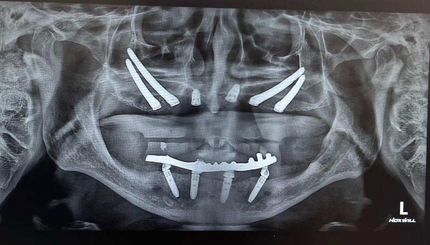 Имплантация Zygoma