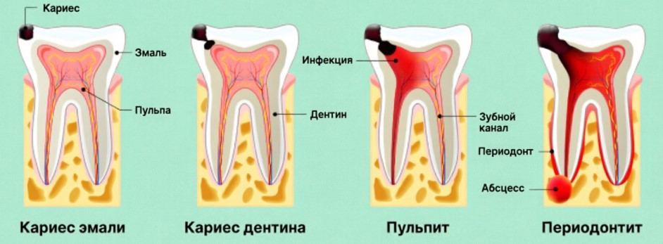 Кариес, пульпит, периодонтит схема