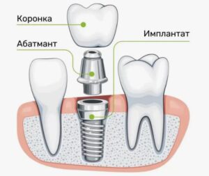 Двухэтапная имплантация