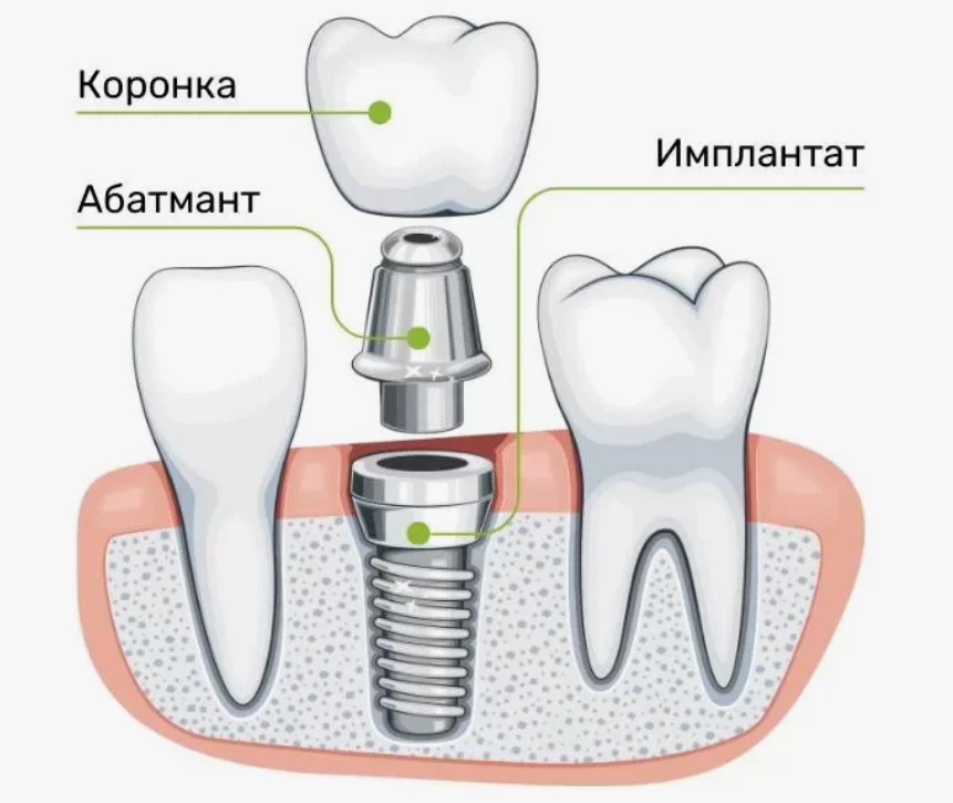 Двухэтапная имплантация