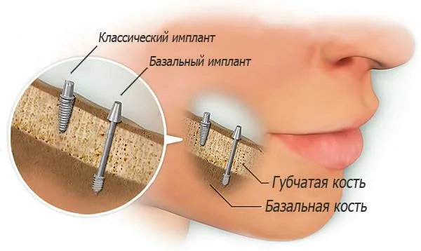 Базальная имплантация зубов