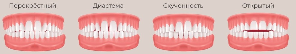 Виды прикуса