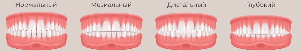 Виды прикуса